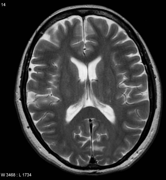 File:Amyotrophic lateral sclerosis (Radiopaedia 5373-7134 Axial T2 14).jpg