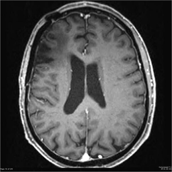File:Anaplastic meningioma with recurrence (Radiopaedia 34452-35788 Axial T1 C+ 91).jpg