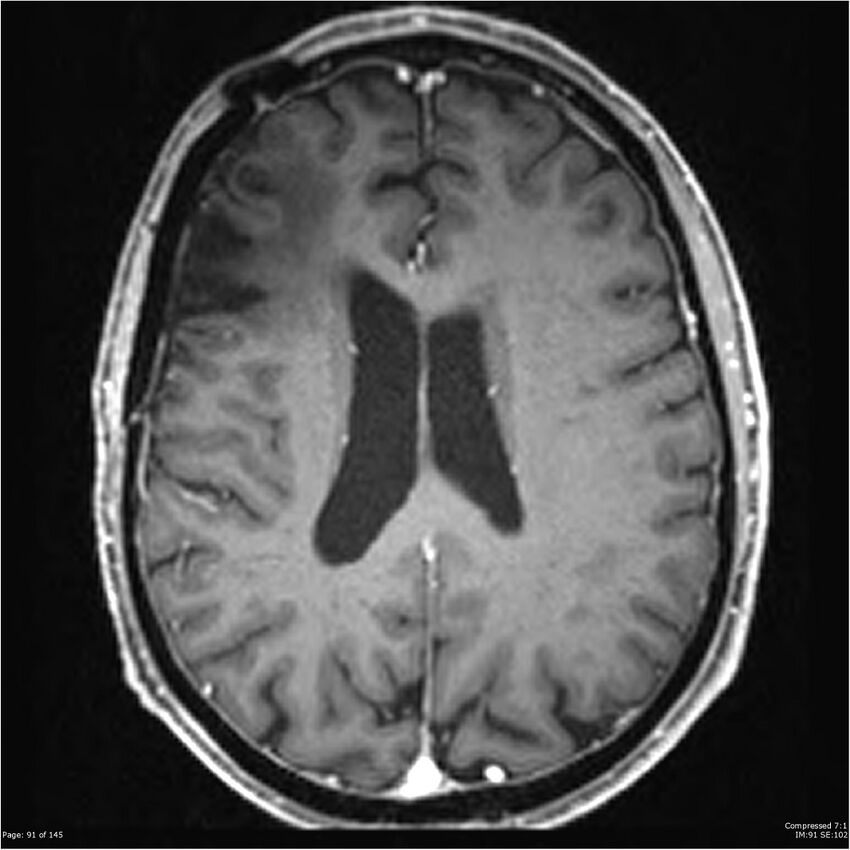 Anaplastic meningioma with recurrence (Radiopaedia 34452-35788 Axial T1 C+ 91).jpg