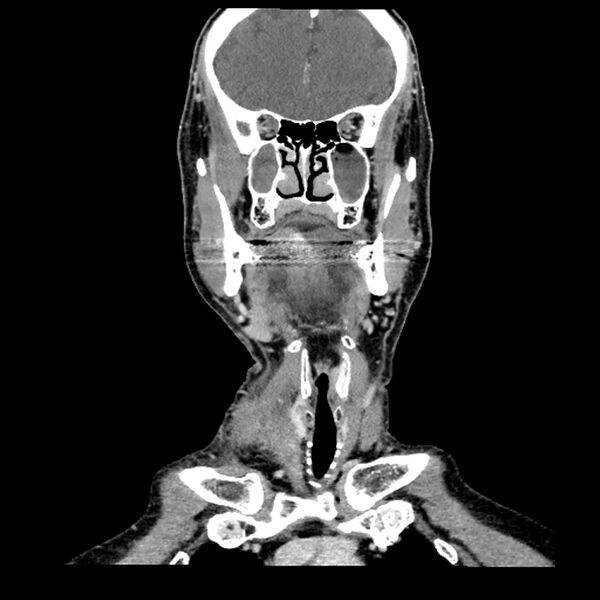 File:Anaplastic thyroid carcinoma (Radiopaedia 79087-92034 A 47).jpg
