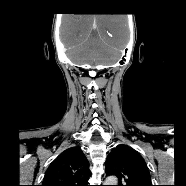 File:Anaplastic thyroid carcinoma (Radiopaedia 79087-92034 A 89).jpg