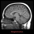 Anatomy- sulci of the brain (Radiopaedia 33834-34995 Marginal sulcus 1).jpg