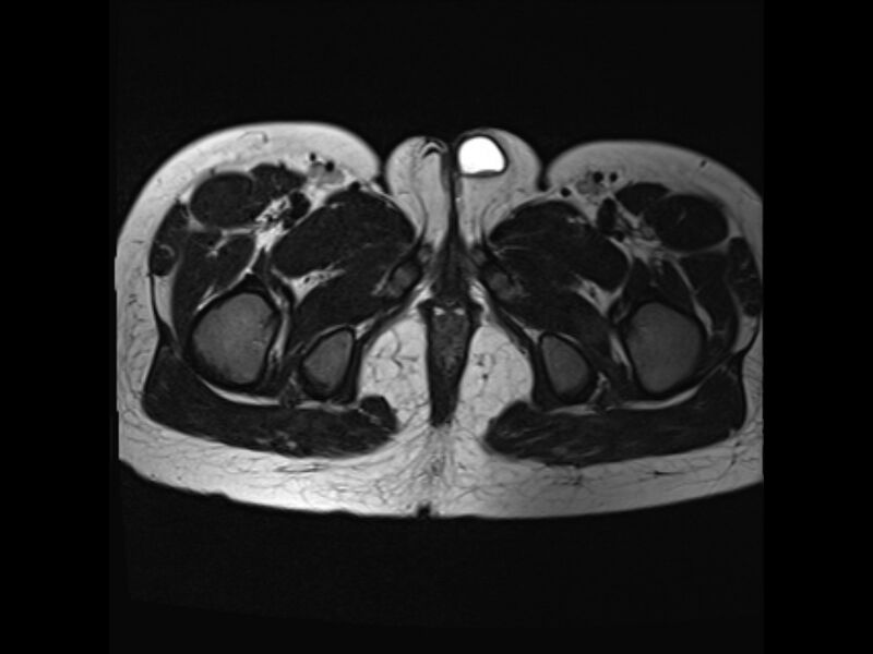 File:Androgen insensitivity syndrome (Radiopaedia 42046-45081 Axial T2 28).jpg