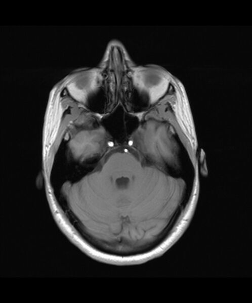 File:Angiomatous meningioma (Radiopaedia 79459-92579 Axial T1 7).jpg