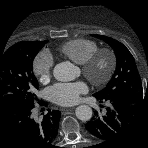 File:Anomalous origin of left circumflex artery from right coronary sinus (Radiopaedia 72563-83117 B 53).jpg
