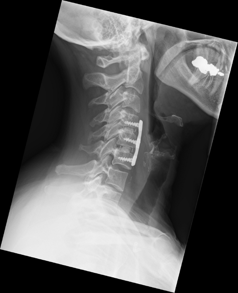 File:Anterior cervical discectomy and fusion (ACDF) (Radiopaedia 38120-40109 Lateral 1).png