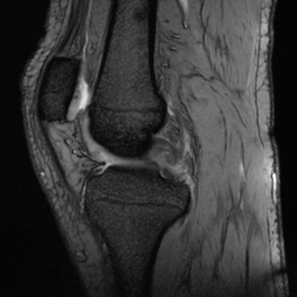 File:Anterior cruciate ligament tear - ramp lesion (Radiopaedia 71883-82322 Sagittal T2 fat sat 15).jpg
