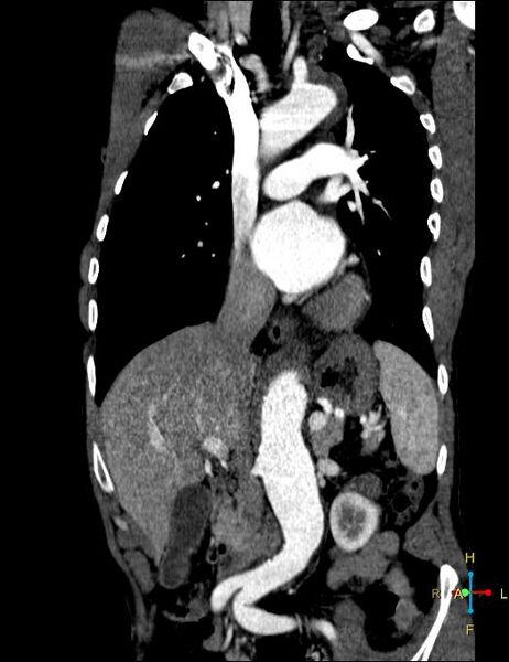 File:Aortic aneurysm and penetrating ulcer (Radiopaedia 23590-23704 B 5).jpg