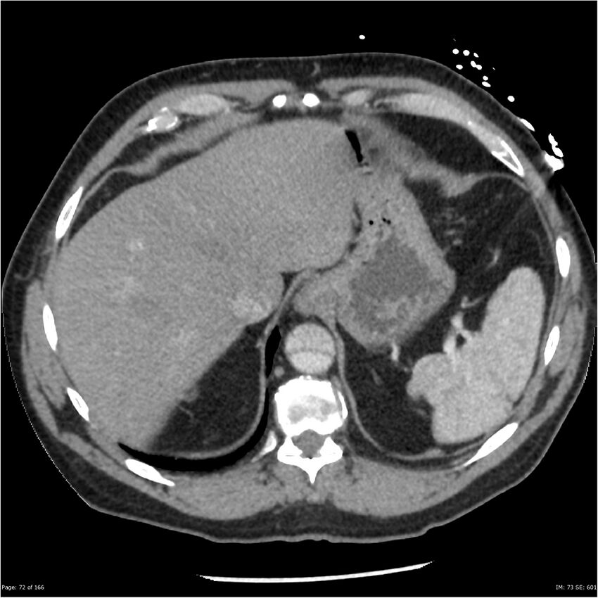 Aortic dissection- Stanford A (Radiopaedia 37759-39664 A 63).jpg