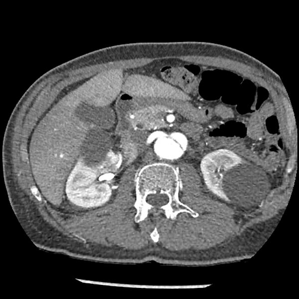 File:Aortic dissection - DeBakey Type I-Stanford A (Radiopaedia 79863-93115 A 48).jpg