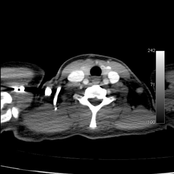 File:Aortic dissection - Stanford type A (Radiopaedia 29247-29659 A 1).jpg