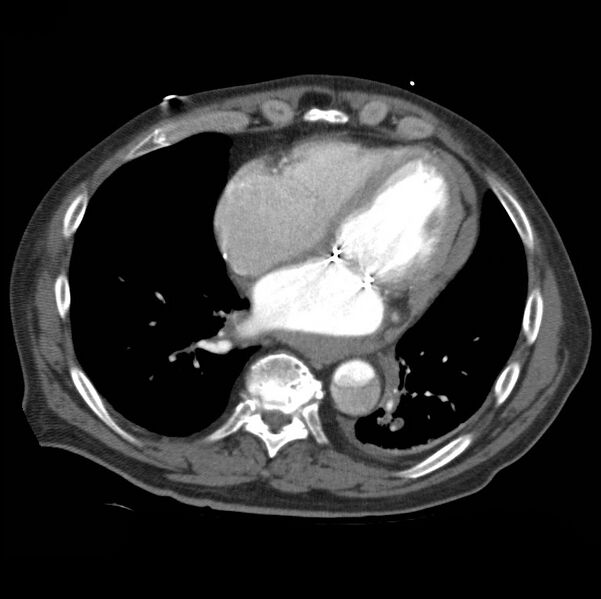 File:Aortic dissection with rupture into pericardium (Radiopaedia 12384-12647 A 39).jpg