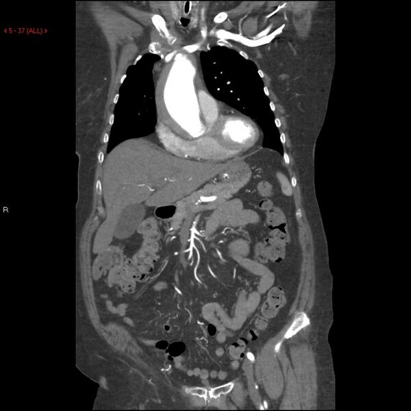 File:Aortic intramural hematoma (Radiopaedia 27746-28001 B 14).jpg