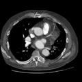 Aorto-coronary bypass graft aneurysms (Radiopaedia 40562-43157 A 62).png