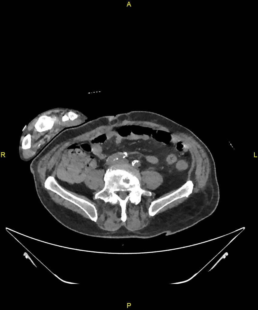 Aortoenteric fistula (Radiopaedia 84308-99603 Axial non-contrast 244).jpg