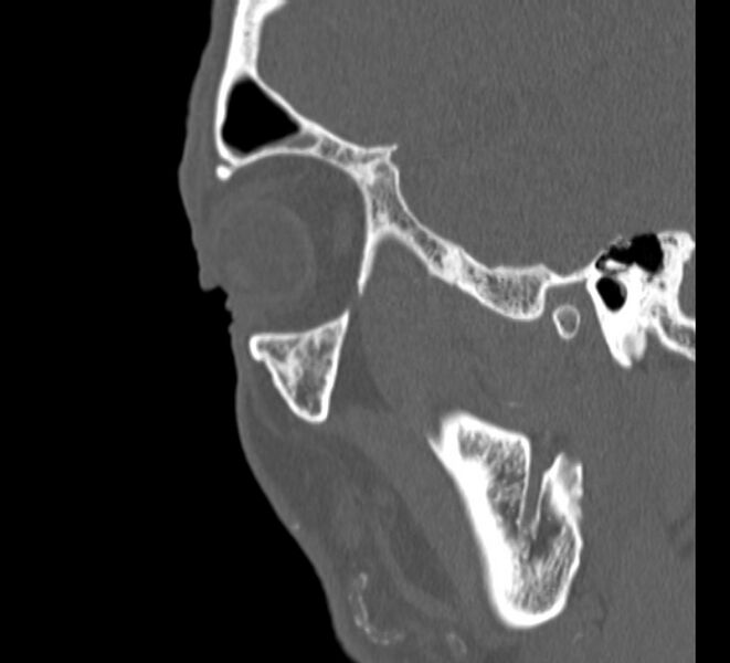 File:Aplastic maxillary sinuses (Radiopaedia 60030-67561 Sagittal bone window 29).jpg