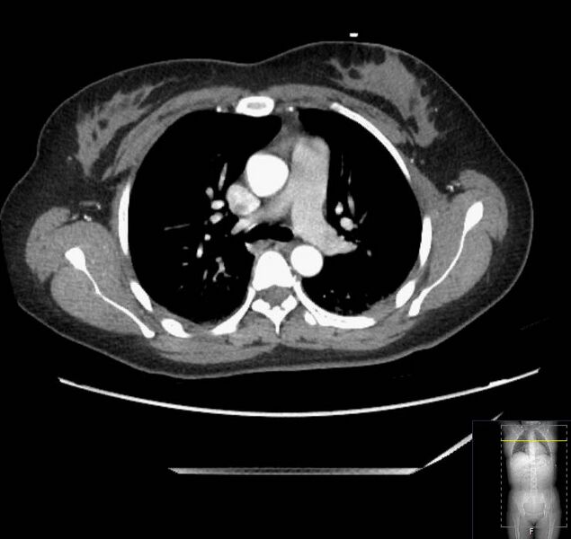 File:Appendicitis (CT angiogram) (Radiopaedia 154713-127660 Axial 210).jpg