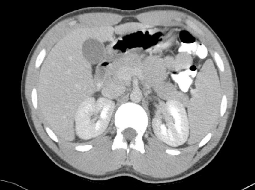 Appendicitis and incidental foregut duplication cyst (Radiopaedia 52962-58916 A 7).jpg