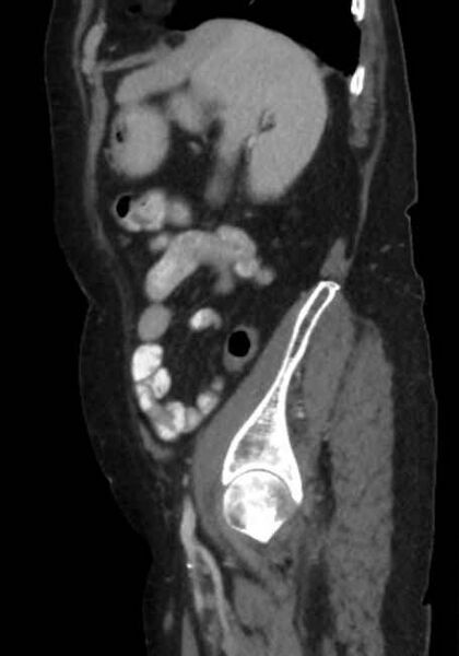 File:Appendicitis due to chicken fibula (Radiopaedia 74314-85198 C 81).jpg