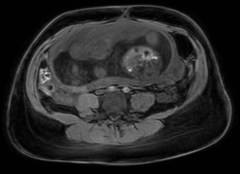 File:Appendicitis in gravida (MRI) (Radiopaedia 89433-106395 Axial DIXON 86).jpg