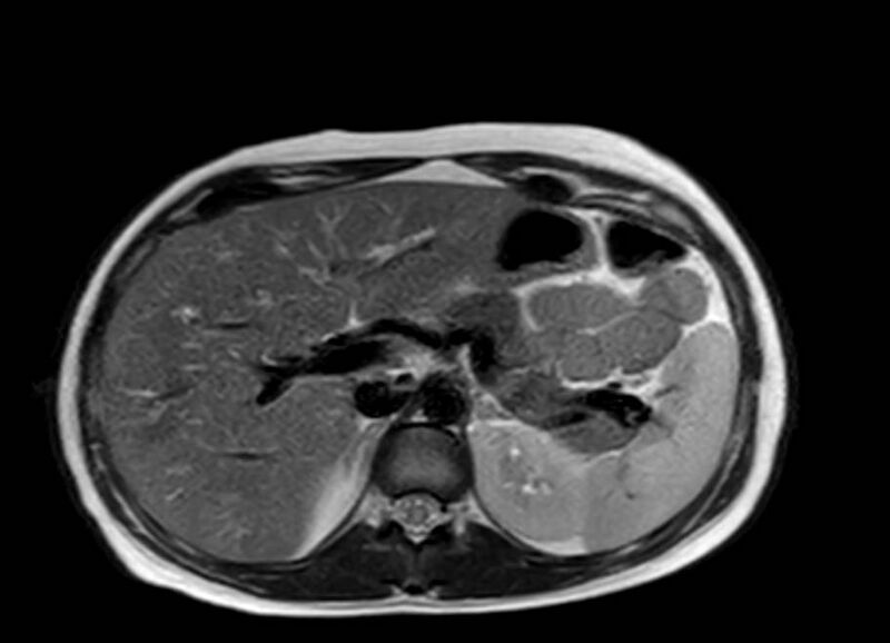 File:Appendicitis in gravida (MRI) (Radiopaedia 89433-106395 Axial T2 14).jpg