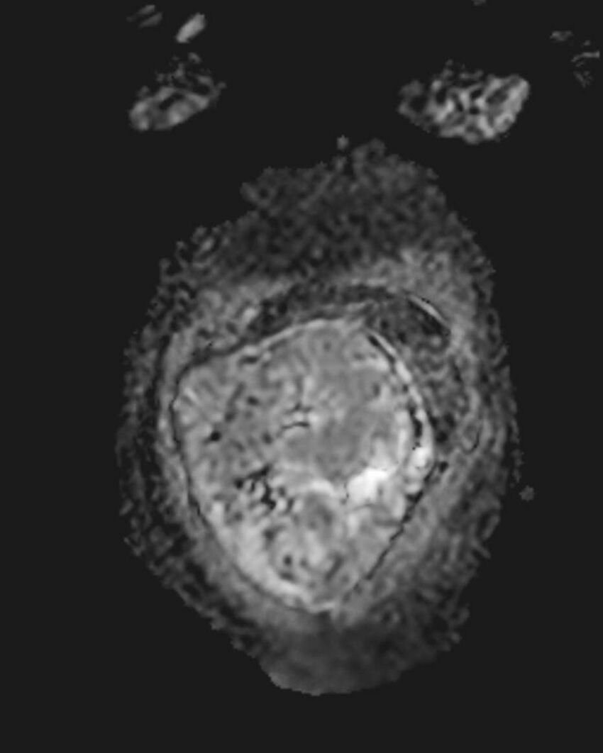 Appendicitis in gravida (MRI) (Radiopaedia 89433-106395 Coronal ADC 10).jpg