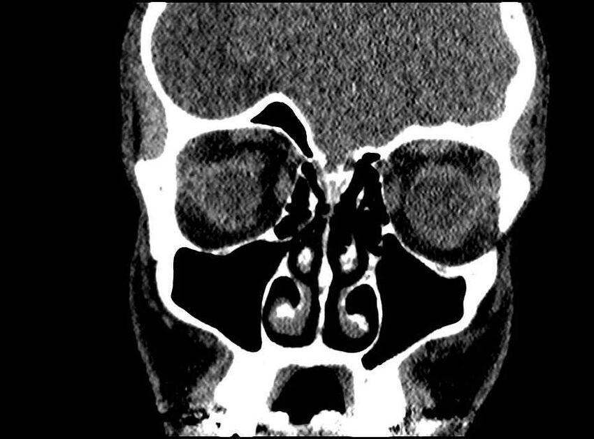 Arachnoid cyst- extremely large (Radiopaedia 68741-78450 Coronal bone window 54).jpg