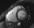 Arrhythmogenic right ventricular cardiomyopathy (Radiopaedia 69564-79464 short axis cine 162).jpg