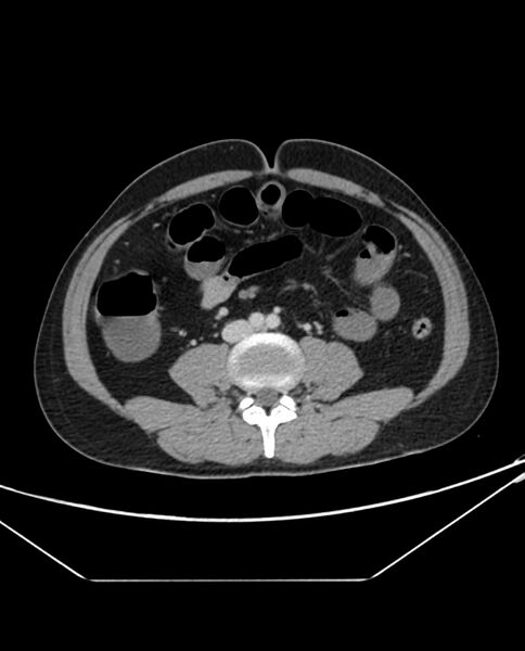File:Arterial occlusive mesenteric ischemia (Radiopaedia 84641-100054 A 69).jpg