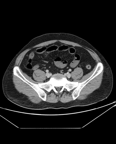 File:Arterial occlusive mesenteric ischemia (Radiopaedia 84641-100054 A 88).jpg