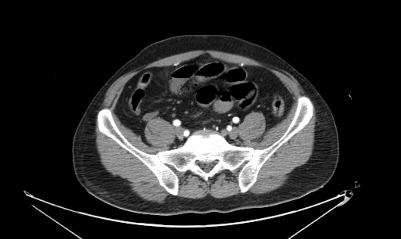 File:Arterial occlusive mesenteric ischemia (Radiopaedia 84641-100060 A 98).jpg