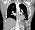 Ascending aortic aneurysm (Radiopaedia 86279-102297 B 43).jpg