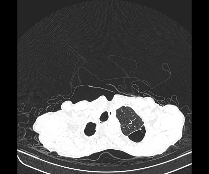 File:Aspergillomas (Radiopaedia 66779-76110 Axial lung window 12).jpg