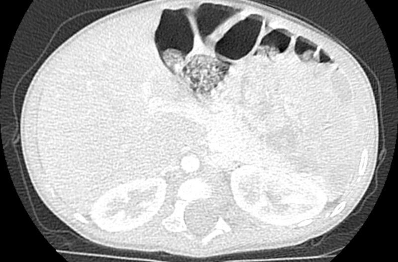 File:Asplenia syndrome (Radiopaedia 73083-83792 Axial lung window 84).jpg