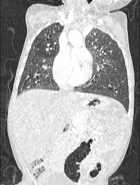 File:Asplenia syndrome (Radiopaedia 73083-83792 Coronal lung window 60).jpg