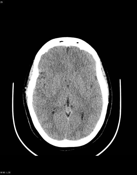 File:Astroblastoma (Radiopaedia 39792-42216 Axial non-contrast 24).jpg