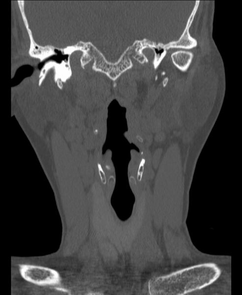 File:Atlanto-occipital assimilation with basilar invagination (Radiopaedia 70122-80188 Coronal bone window 26).jpg