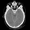 Atlanto-occipital dislocation (Radiopaedia 44648-48412 Axial non-contrast 21).jpg