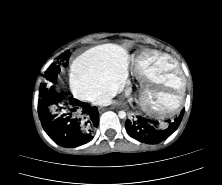 File:Atrial septal defect complicated by Eisenmenger syndrome (Radiopaedia 53707-59768 Axial C+ CTPA 27).jpg