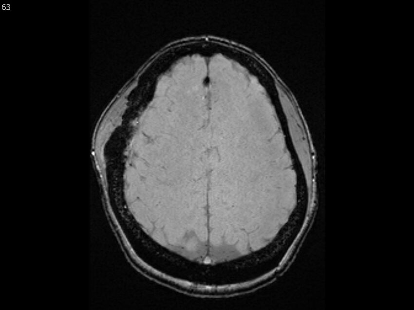 Atypical meningioma - intraosseous (Radiopaedia 64915-74572 Axial SWI 63).jpg