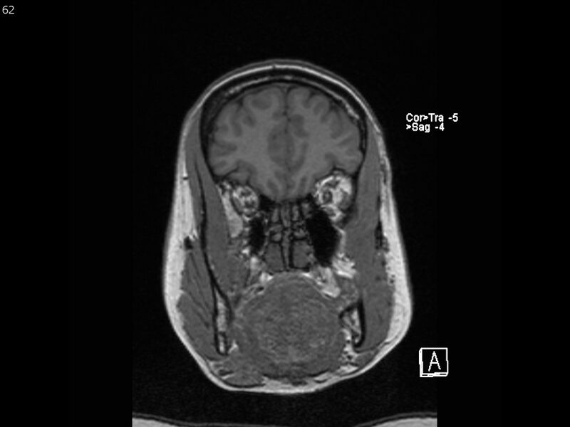 File:Atypical meningioma - intraosseous (Radiopaedia 64915-74572 Coronal T1 62).jpg