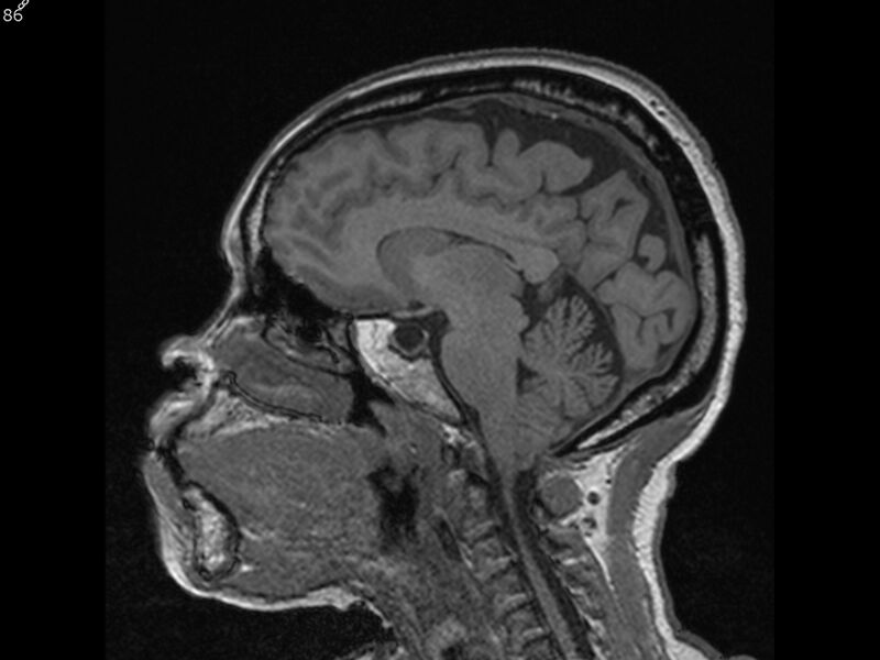 File:Atypical meningioma - intraosseous (Radiopaedia 64915-74572 Sagittal T1 86).jpg