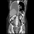 Atypical retroperitoneal lymphocoeles with large leiomyoma of uterus (Radiopaedia 32084-33024 B 14).jpg