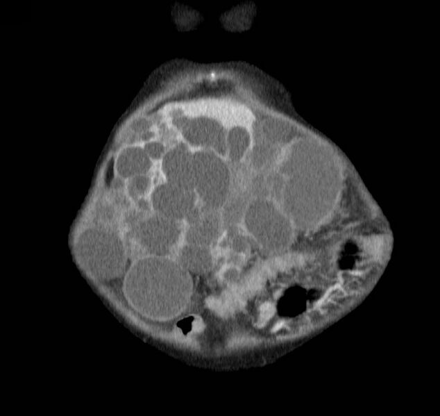 File:Autosomal dominant polycystic kidney disease (Radiopaedia 16777-16490 B 2).jpg