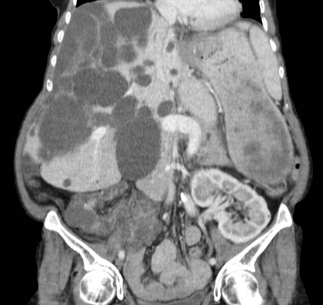 File:Autosomal dominant polycystic kidney disease (Radiopaedia 16777-16490 B 22).jpg