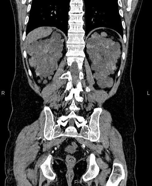File:Autosomal dominant polycystic kidney disease (Radiopaedia 87830-104287 Coronal non-contrast 50).jpg