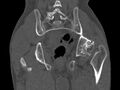 Avascular necrosis of the left hip (Radiopaedia 75068-86125 Coronal bone window 67).jpg