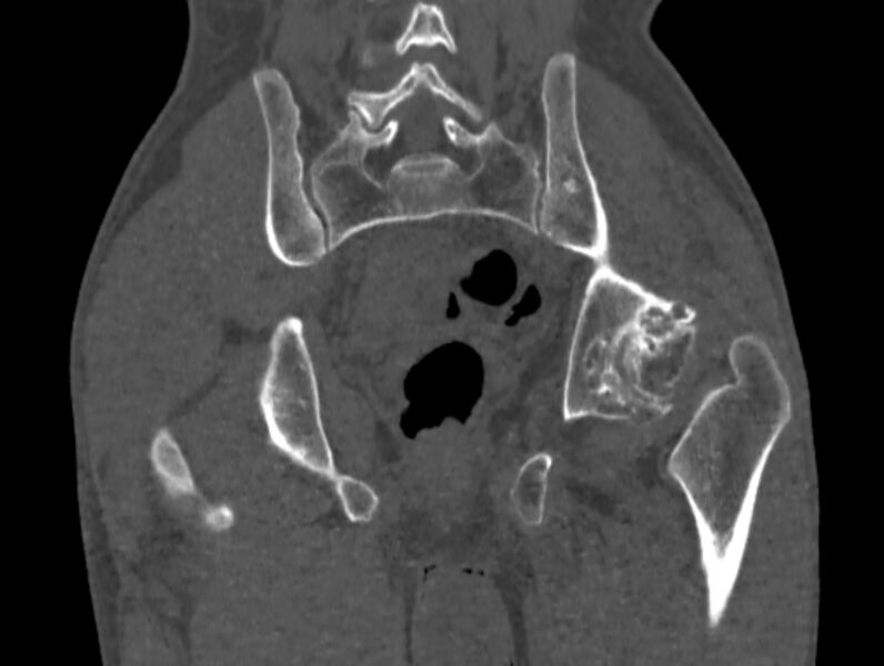 File:Avascular necrosis of the left hip (Radiopaedia 75068-86125 Coronal bone window 67).jpg