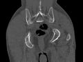 Avascular necrosis of the left hip (Radiopaedia 75068-86125 Coronal bone window 86).jpg
