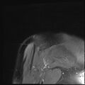 Avulsion fracture - greater tuberosity of humerus (Radiopaedia 71216-81515 Coronal PD fat sat 2).jpg